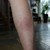 Borrelia 001.JPG